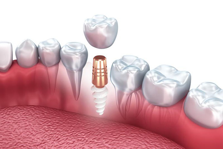 Правда или выдумки? 6 мифов об имплантации зубов ➤ Блог Европейского  Стоматологического Центра (ЕСЦ)
