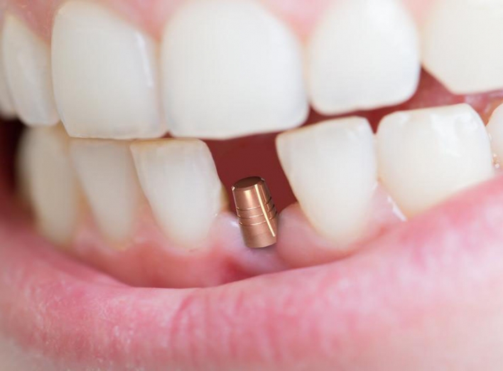 Почему имплантация зубов дорогая: стоит ли процедура своих денег