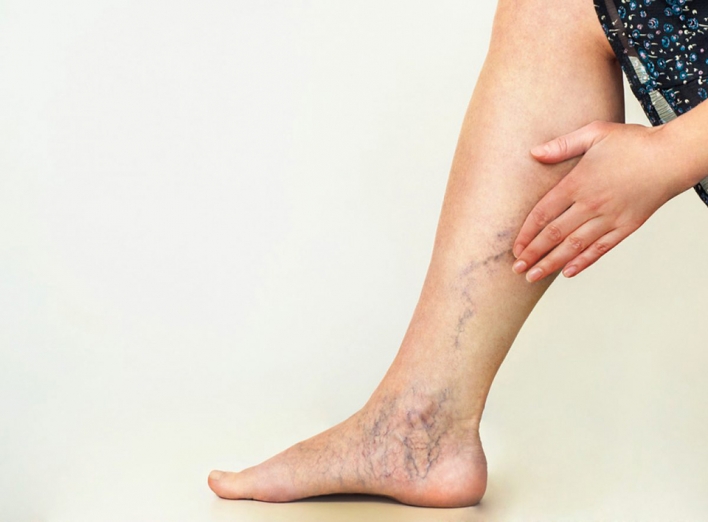 Признаки тромба в ноге: раннее распознавание тромбоза